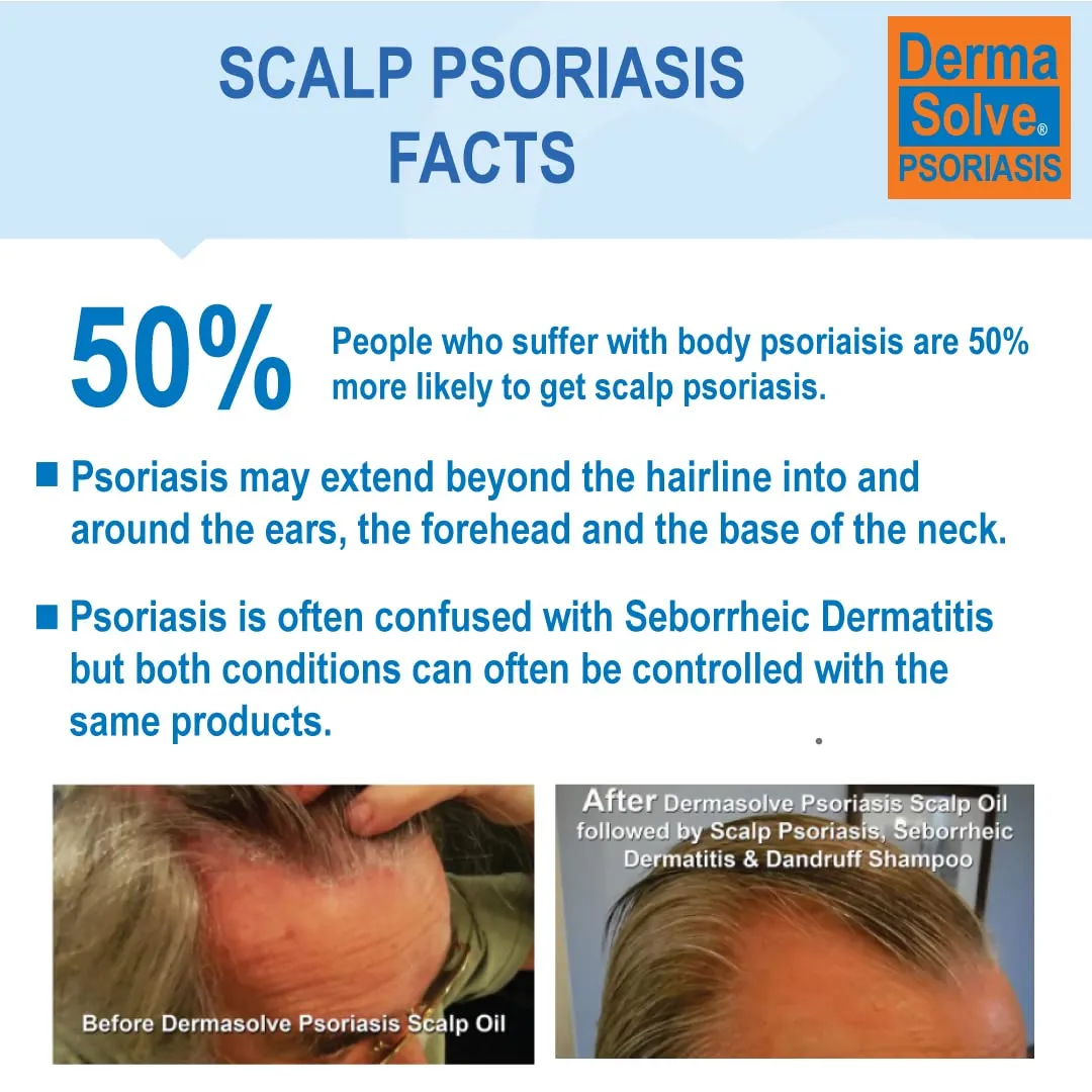 Dermasolve Scalp Psoriasis Medicated Shampoo & Conditioner - Naturally Heals Dandruff Seborrheic Dermatitis Itchy Flakey Inflamed Skin & Provides Soothing Moisturizing Relief - 8 oz bottles (2 Pack)